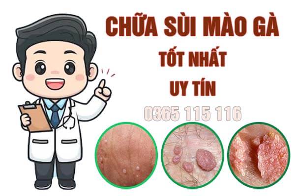 Top 15 địa chỉ khám chữa bệnh sùi mào gà ở đâu Hà Nội tốt nhất 2024