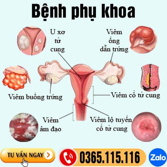 10 bệnh phụ khoa phổ biến thường gặp và dấu hiệu chung