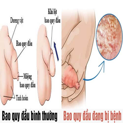 Bao quy đầu như thế nào là bình thường [Cách nhận biết]