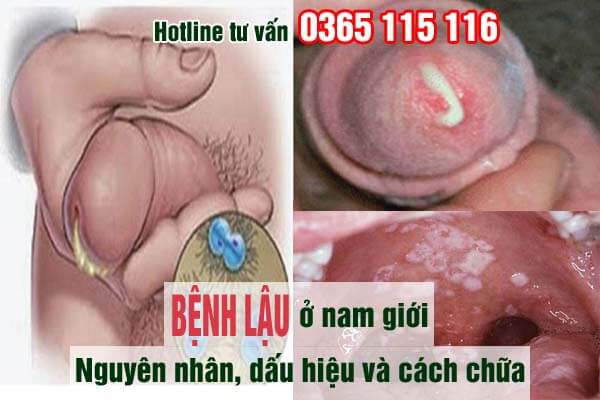 Bệnh lậu ở nam giới: Nguyên nhân, dấu hiệu và cách chữa