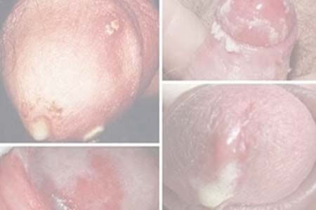 [Bệnh lậu là gì] Dấu hiệu, hình ảnh và triệu chứng ở nam, nữ giới 2026