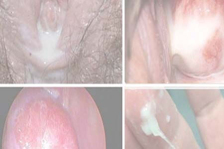 [Bệnh lậu là gì] Dấu hiệu, hình ảnh và triệu chứng ở nam, nữ giới 2026