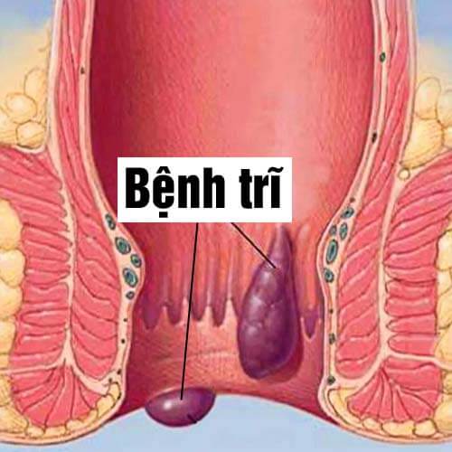 [Bệnh trĩ] Dấu hiệu bị trĩ ngoại, trĩ nội và hình ảnh búi trĩ 2026