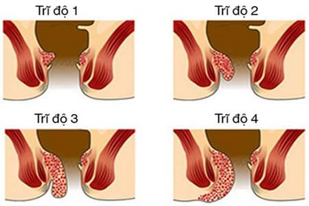 [Bệnh trĩ] Dấu hiệu bị trĩ ngoại, trĩ nội và hình ảnh búi trĩ 2026
