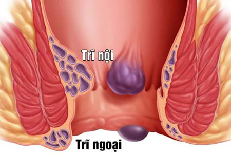 [Bệnh trĩ] Dấu hiệu bị trĩ ngoại, trĩ nội và hình ảnh búi trĩ 2026