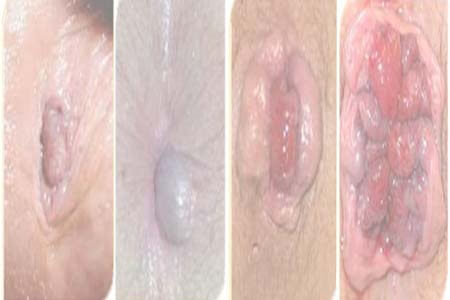 [Bệnh trĩ] Dấu hiệu bị trĩ ngoại, trĩ nội và hình ảnh búi trĩ 2026