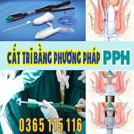 Phương pháp PPH là gì, cắt trĩ bằng phương pháp PPH bao nhiêu tiền