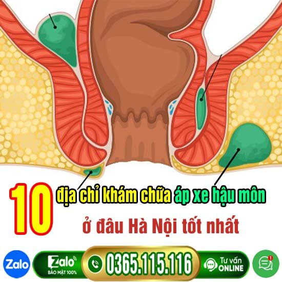 10 địa chỉ khám chữa áp xe hậu môn ở đâu Hà Nội tốt nhất 10 địa chỉ khám chữa áp xe hậu môn ở đâu Hà Nội tốt nhất