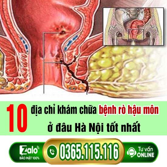10 địa chỉ khám chữa bệnh rò hậu môn ở đâu Hà Nội tốt nhất 10 địa chỉ khám chữa bệnh rò hậu môn ở đâu Hà Nội tốt nhất
