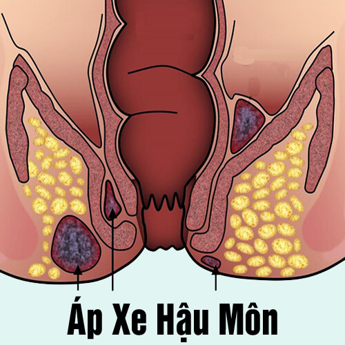[Áp Xe Hậu Môn] Triệu chứng, cách điều trị và chi phí mổ 2026 Hà Nội