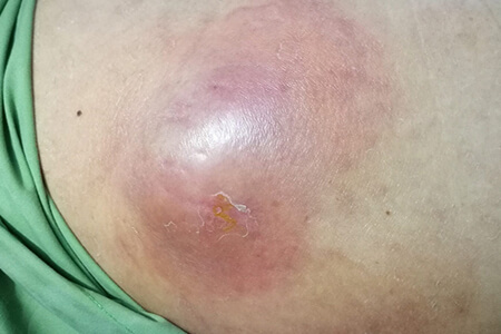 [Áp Xe Hậu Môn] Triệu chứng, cách điều trị và chi phí mổ 2026 Hà Nội