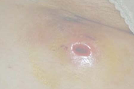 [Rò hậu môn] Triệu chứng, hình ảnh và cách chữa dứt điểm 2026