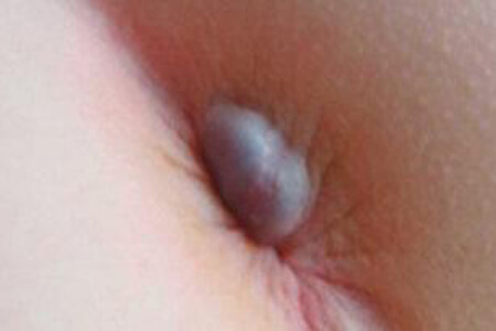 [Áp Xe Hậu Môn] Triệu chứng, cách điều trị và chi phí mổ 2026 Hà Nội