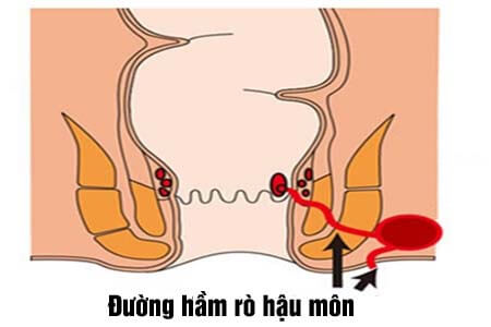 [Rò hậu môn] Triệu chứng, hình ảnh và cách chữa dứt điểm 2026