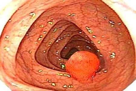 [Polyp Hậu Môn] Dấu hiệu, hình ảnh, cách điều trị và chi phí cắt 2026