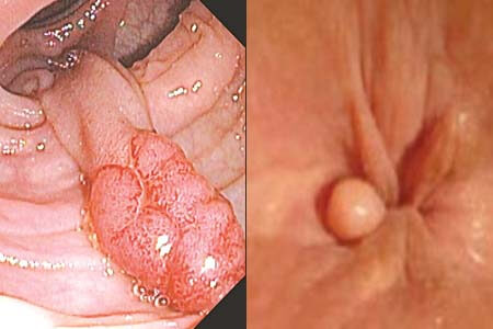 [Polyp Hậu Môn] Dấu hiệu, hình ảnh, cách điều trị và chi phí cắt 2026