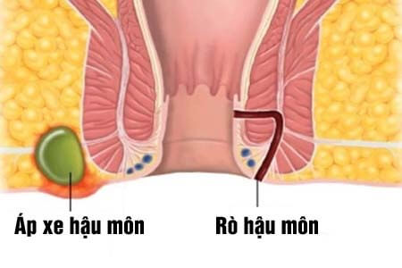 [Rò hậu môn] Triệu chứng, hình ảnh và cách chữa dứt điểm 2026