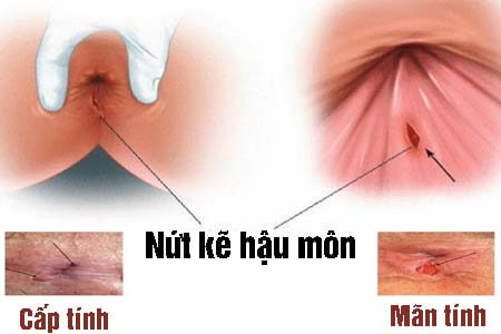 Nứt kẽ hậu môn là gì? Dấu hiệu, nguyên nhân và cách điều trị Nứt kẽ hậu môn là gì? Dấu hiệu, nguyên nhân và cách điều trị
