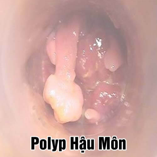 [Polyp Hậu Môn] Dấu hiệu, hình ảnh, cách điều trị và chi phí cắt 2026