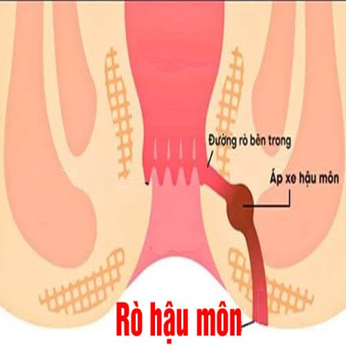 [Rò hậu môn] Triệu chứng, hình ảnh và cách chữa dứt điểm 2026