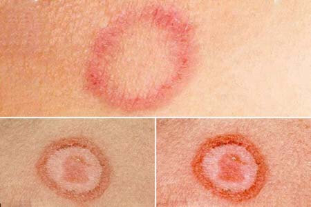 [Bệnh giang mai là gì] Triệu chứng và hình ảnh giai đoạn đầu 2026