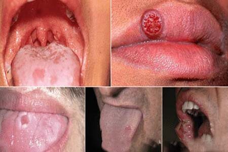 [Bệnh giang mai là gì] Triệu chứng và hình ảnh giai đoạn đầu 2026