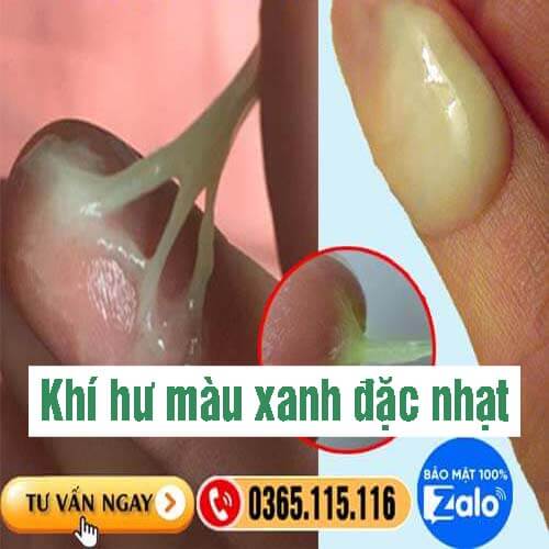 Khí hư màu xanh đặc nhạt như nước mũi Khí hư màu xanh đặc nhạt như nước mũi