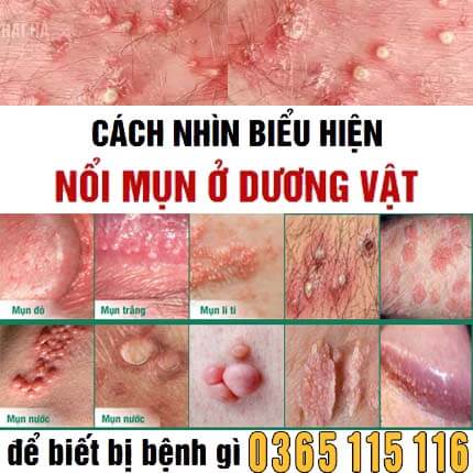 Cách nhìn biểu hiện nổi mụn ở dương vật để biết bị bệnh gì Cách nhìn biểu hiện nổi mụn ở dương vật để biết bị bệnh gì