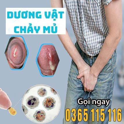 Dương vật chảy mủ là bệnh gì: Nguyên nhân và cách điều trị Dương vật chảy mủ là bệnh gì: Nguyên nhân và cách điều trị