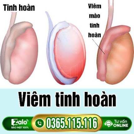 Viêm tinh hoàn: Nguyên nhân, dấu hiệu và điều trị