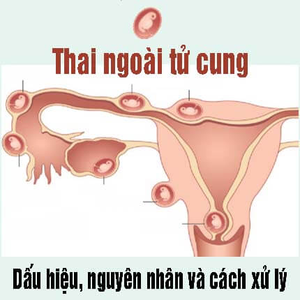 Thai ngoài tử cung: Dấu hiệu, nguyên nhân và cách xử lý Thai ngoài tử cung: Dấu hiệu, nguyên nhân và cách xử lý