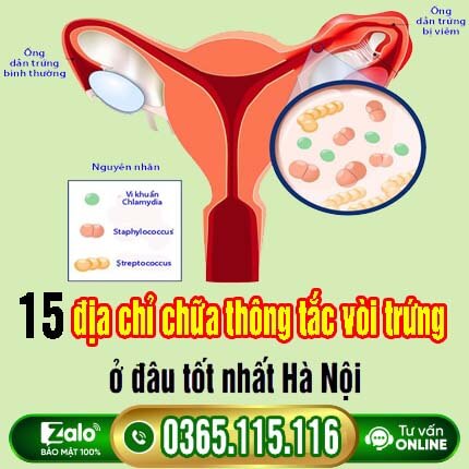 15 địa chỉ chữa thông tắc vòi trứng ở đâu tốt nhất Hà Nội 15 địa chỉ chữa thông tắc vòi trứng ở đâu tốt nhất Hà Nội