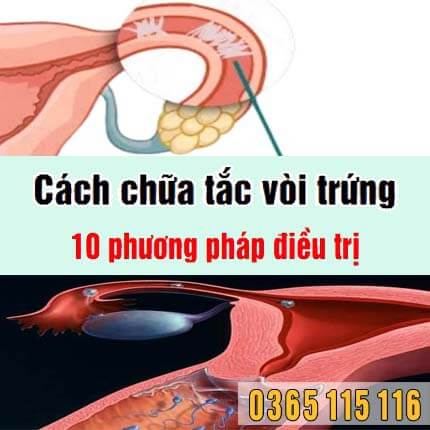 Cách chữa tắc vòi trứng: Top 10 phương pháp điều trị Cách chữa tắc vòi trứng: Top 10 phương pháp điều trị