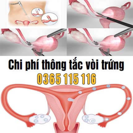 Chi phí thông tắc vòi trứng giá bao nhiêu: Bảng giá 2026