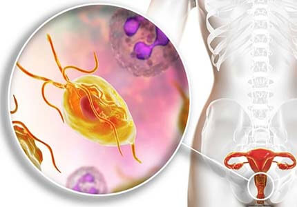 Viêm âm đạo: Dấu hiệu bị, hình ảnh và nguyên nhân Viêm âm đạo: Dấu hiệu bị, hình ảnh và nguyên nhân