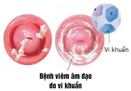 Viêm âm đạo: Dấu hiệu bị, hình ảnh và nguyên nhân Viêm âm đạo: Dấu hiệu bị, hình ảnh và nguyên nhân