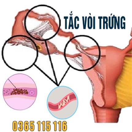 Tắc vòi trứng: Nguyên nhân, dấu hiệu, chẩn đoán, điều trị
