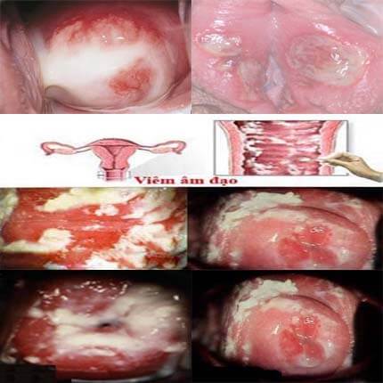Viêm âm đạo: Dấu hiệu bị, hình ảnh và nguyên nhân Viêm âm đạo: Dấu hiệu bị, hình ảnh và nguyên nhân