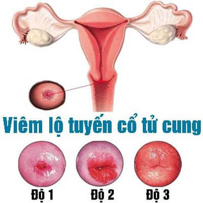 Viêm lộ tuyến cổ tử cung: Triệu chứng, Nguyên nhân và Điều trị