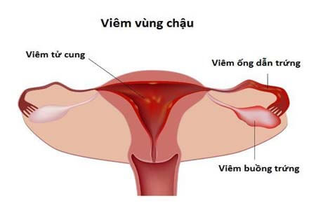 Viêm vùng chậu là bệnh gì? Nguyên nhân, triệu chứng và khám ở đâu Viêm vùng chậu là bệnh gì? Nguyên nhân, triệu chứng và khám ở đâu
