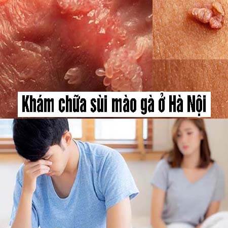 10 địa chỉ khám chữa sùi mào gà uy tín ở đâu tốt nhất Hà Nội