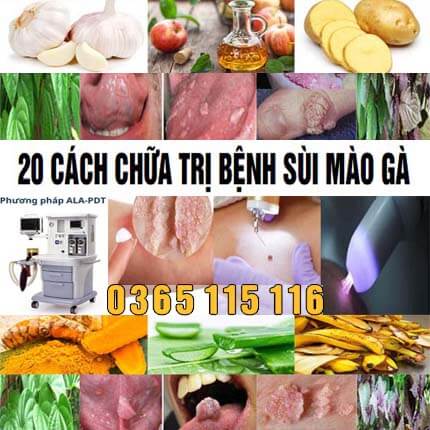 20 cách chữa trị bệnh sùi mào gà hiệu quả nhất tại nhà