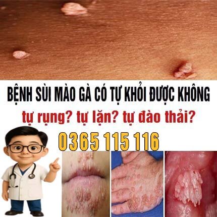 Bệnh sùi mào gà có tự khỏi được không (rụng lặn đào thải) Bệnh sùi mào gà có tự khỏi được không (rụng lặn đào thải)