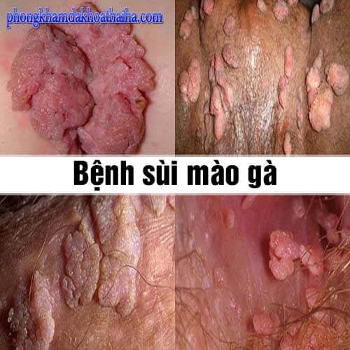 [Bệnh sùi mào gà là gì] Nguyên nhân, dấu hiệu và cách điều trị 2026