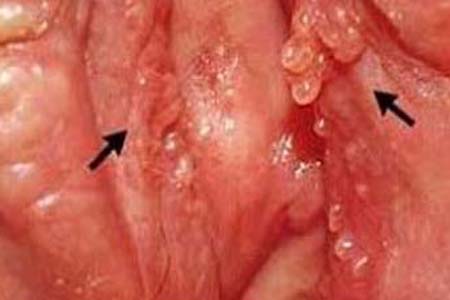 30 Hình ảnh sùi mào gà ở khắp cơ thể người bệnh