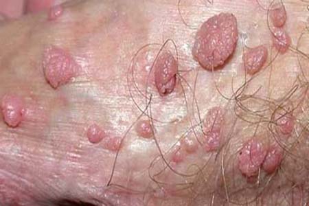 30 Hình ảnh sùi mào gà ở khắp cơ thể người bệnh