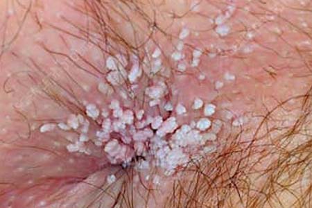 30 Hình ảnh sùi mào gà ở khắp cơ thể người bệnh