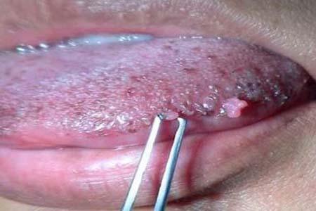 30 Hình ảnh sùi mào gà ở khắp cơ thể người bệnh