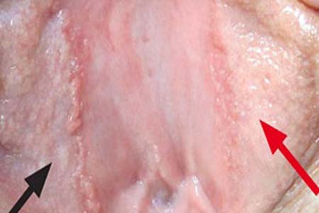 30 Hình ảnh sùi mào gà ở khắp cơ thể người bệnh