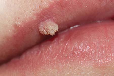30 Hình ảnh sùi mào gà ở khắp cơ thể người bệnh